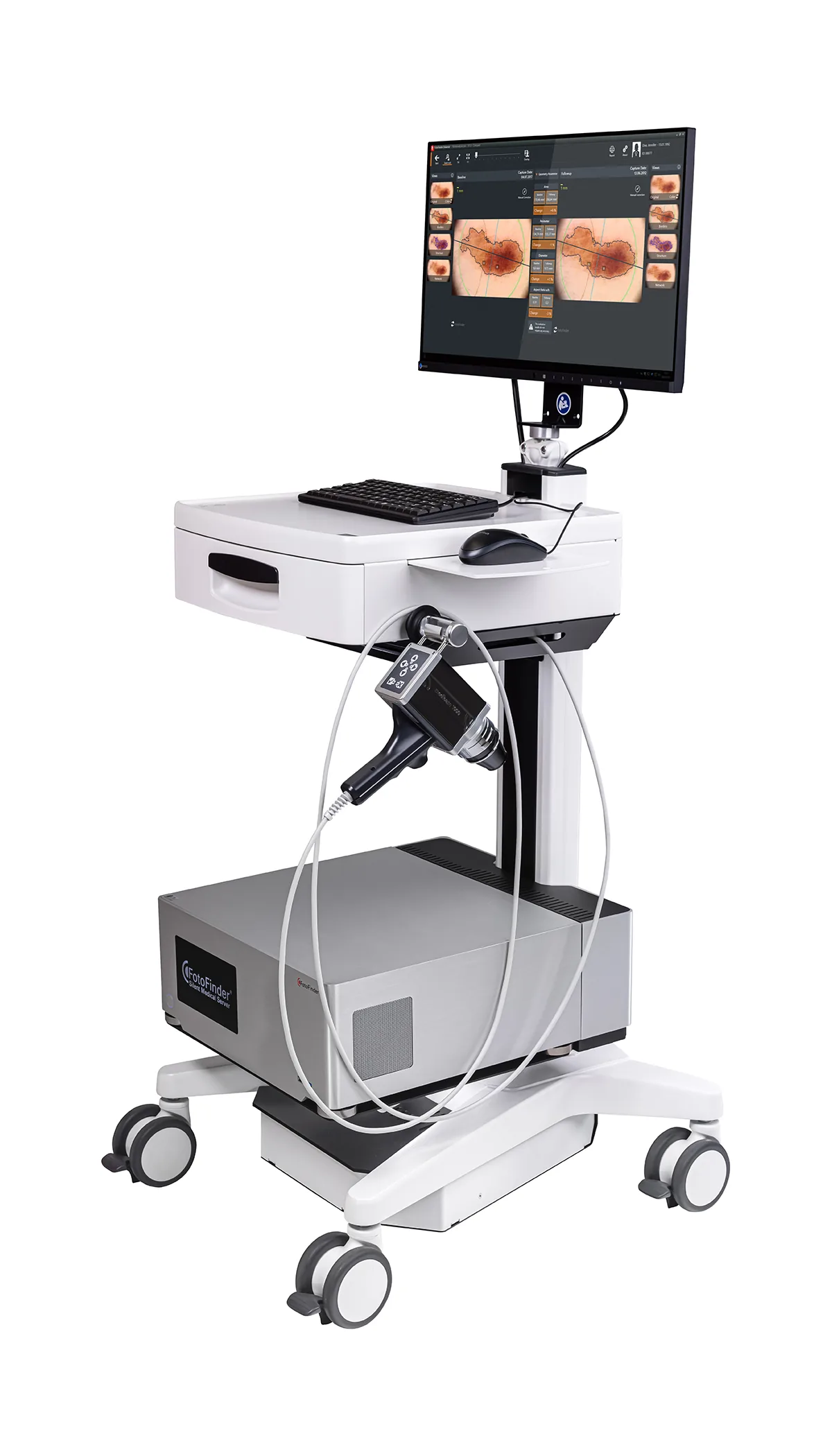 System FotoFinder – diagnostyka znamion cyfrowa