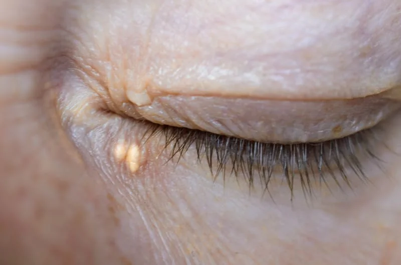 Kępki żółte powiek – xanthelasma palpebrarum