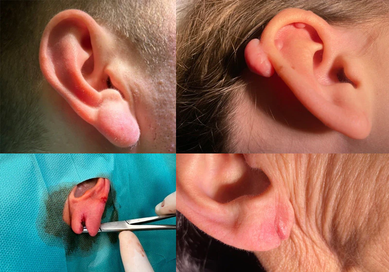 Korekta małżowin usznych – otoplastyka