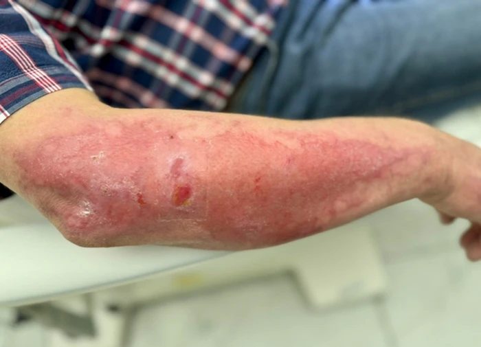 Leczenie blizn laserem CO2 i PRP