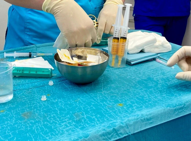 Lipofilling – efekty zabiegu 1