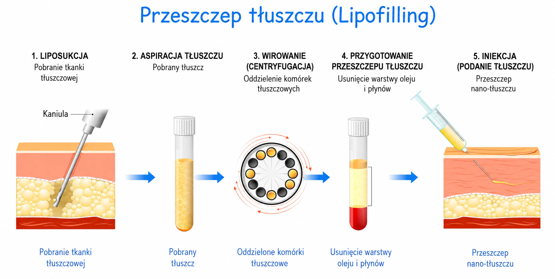 Lipofilling – efekty zabiegu 2