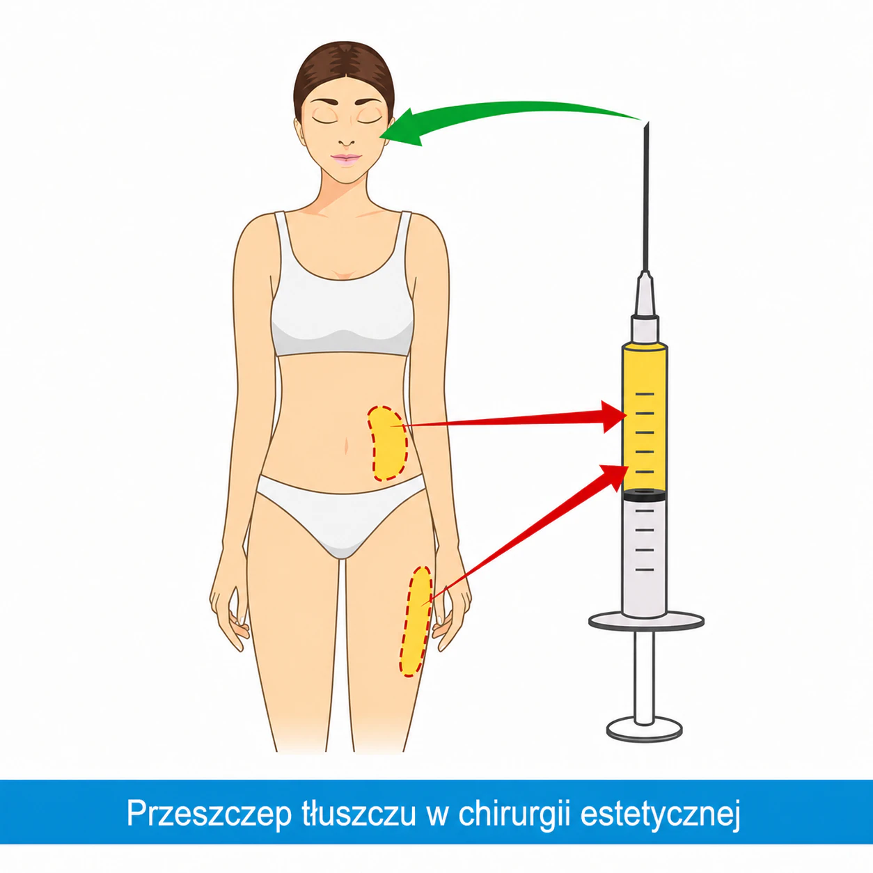 Lipofilling – efekty zabiegu 3