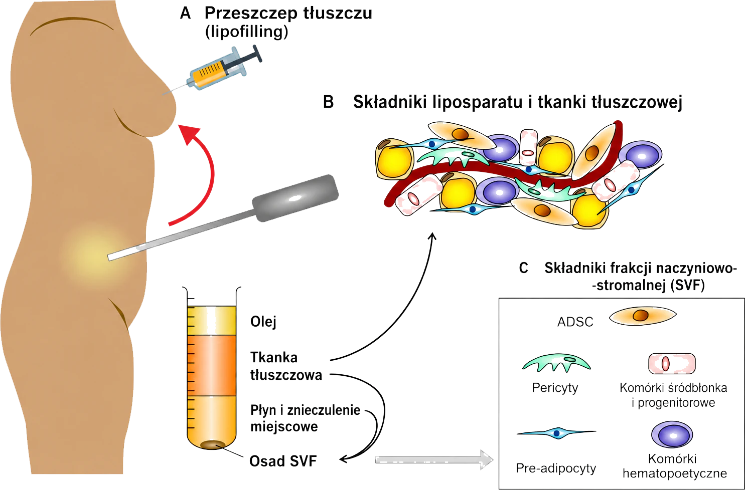 Lipofilling – efekty zabiegu 4