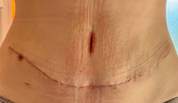Rozejście mięśni prostych brzucha – diastasis recti