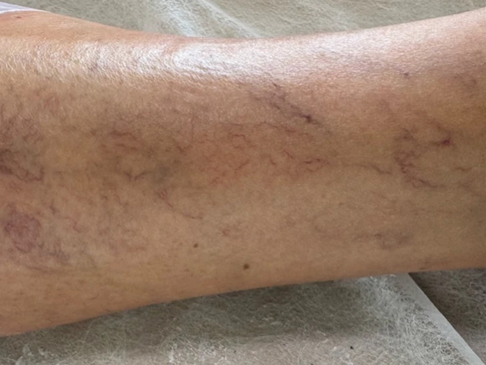 Skleroterapia – efekty leczenia 1