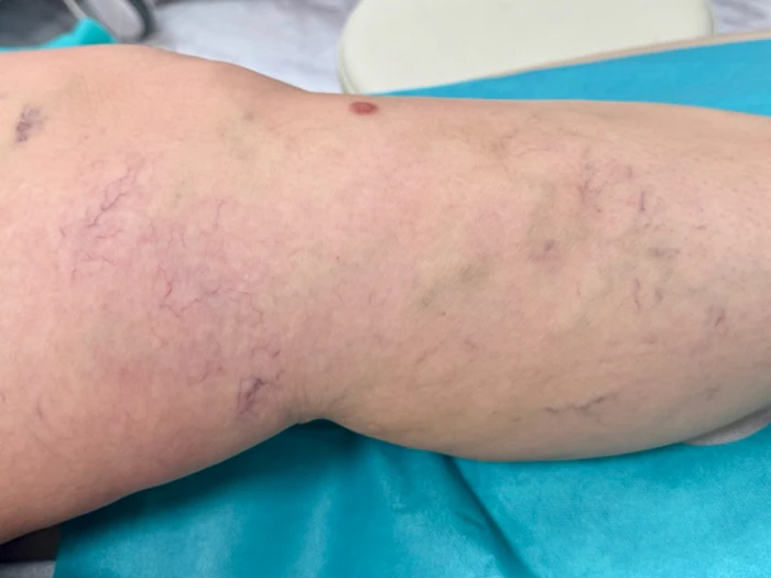 Skleroterapia – efekty leczenia 2