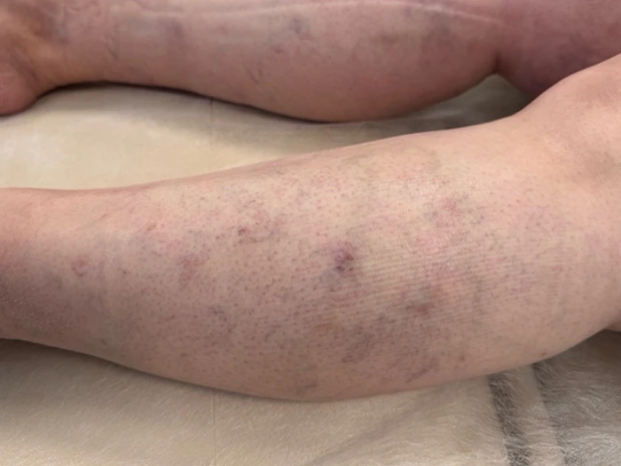 Skleroterapia – efekty leczenia 3