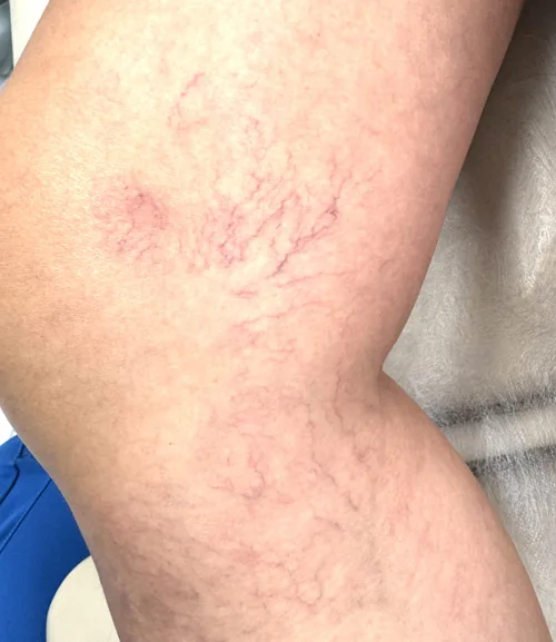 Skleroterapia – efekty leczenia 7