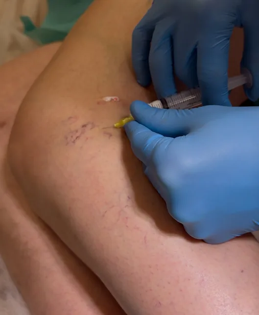 Skleroterapia – efekty leczenia 8